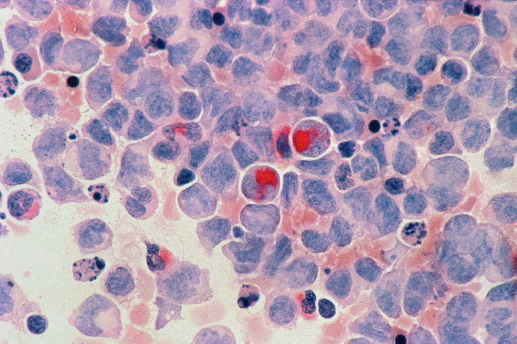 a picture of some cells which could be colon cancer